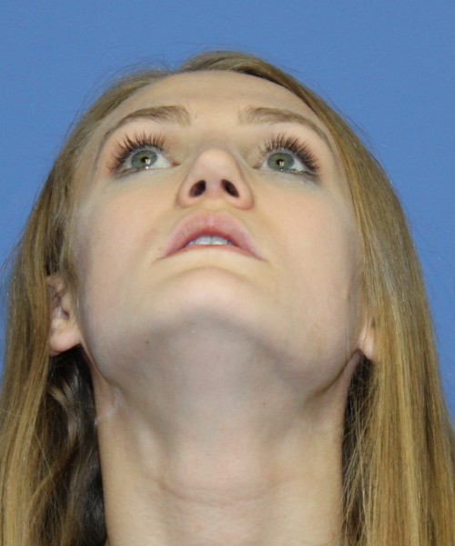 Revision Rhinoplasty 4234 – Click HERE for more views after photo. Individual results may vary.
