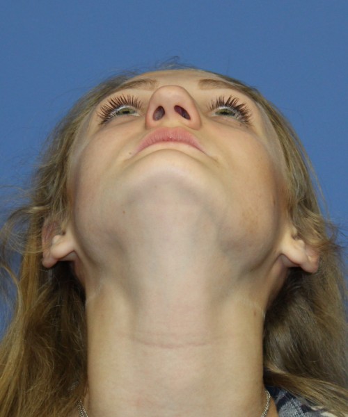 Revision Rhinoplasty 4234 – Click HERE for more views before photo. Individual results may vary.