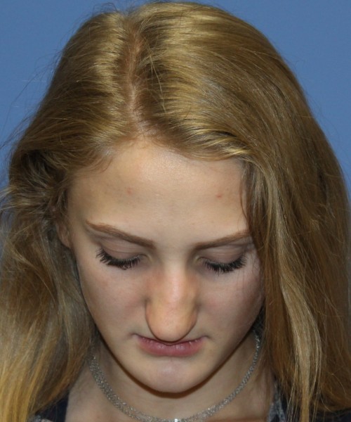Revision Rhinoplasty 4234 – Click HERE for more views before photo. Individual results may vary.
