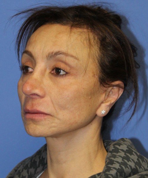 Revision Rhinoplasty, Facelift, Browlift, SMAS Lip Augmentation, Laser Skin Resurfacing 4274 – Click HERE for more views after photo. Individual results may vary.