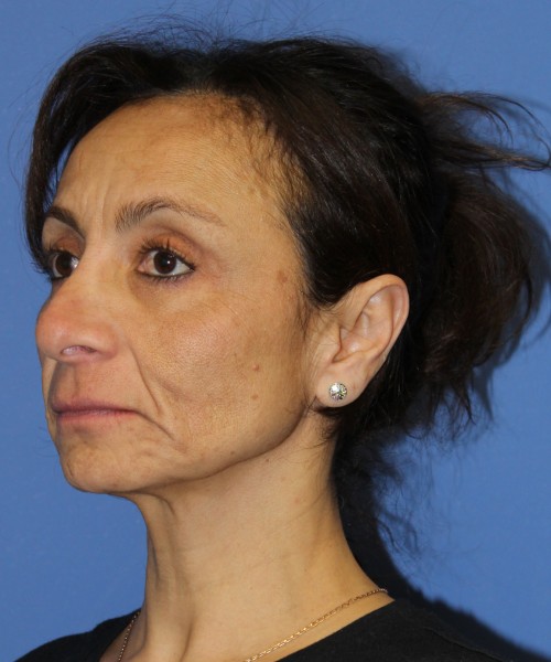 Revision Rhinoplasty, Facelift, Browlift, SMAS Lip Augmentation, Laser Skin Resurfacing 4274 – Click HERE for more views before photo. Individual results may vary.