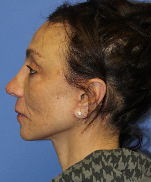 Revision Rhinoplasty, Facelift, Browlift, SMAS Lip Augmentation, Laser Skin Resurfacing 4274 – Click HERE for more views after photo. Individual results may vary.