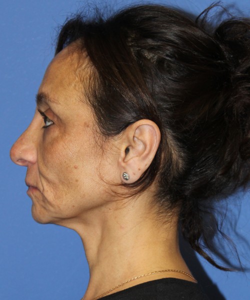 Revision Rhinoplasty, Facelift, Browlift, SMAS Lip Augmentation, Laser Skin Resurfacing 4274 – Click HERE for more views before photo. Individual results may vary.