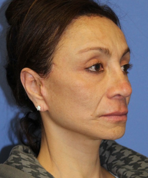 Revision Rhinoplasty, Facelift, Browlift, SMAS Lip Augmentation, Laser Skin Resurfacing 4274 – Click HERE for more views after photo. Individual results may vary.