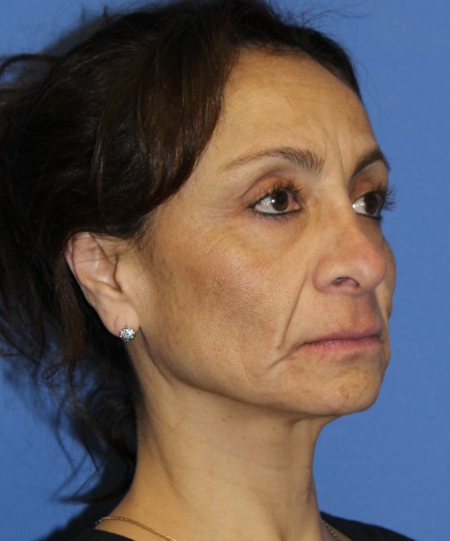 Revision Rhinoplasty, Facelift, Browlift, SMAS Lip Augmentation, Laser Skin Resurfacing 4274 – Click HERE for more views before photo. Individual results may vary.