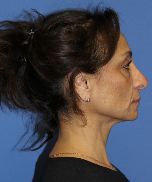 Revision Rhinoplasty, Facelift, Browlift, SMAS Lip Augmentation, Laser Skin Resurfacing 4274 – Click HERE for more views before photo. Individual results may vary.