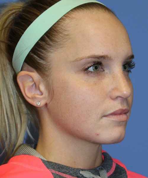 Revision Rhinoplasty 4285 – Click HERE for more views after photo. Individual results may vary.