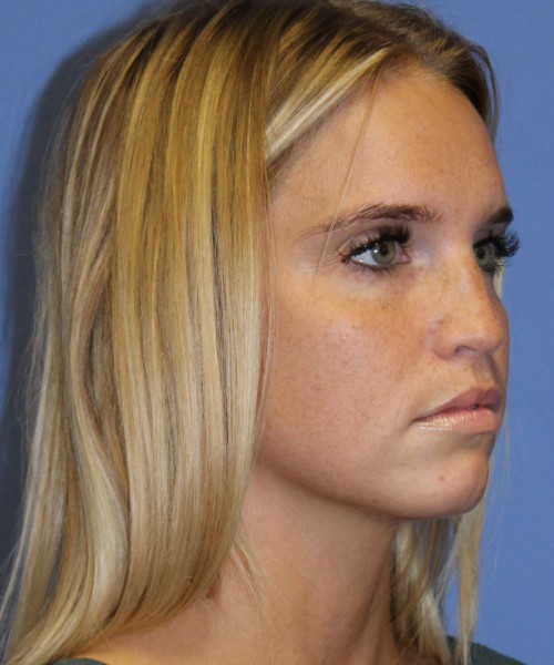 Revision Rhinoplasty 4285 – Click HERE for more views before photo. Individual results may vary.