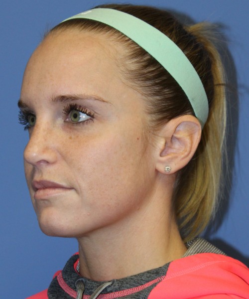 Revision Rhinoplasty 4285 – Click HERE for more views after photo. Individual results may vary.