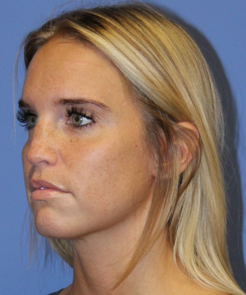 Revision Rhinoplasty 4285 – Click HERE for more views before photo. Individual results may vary.