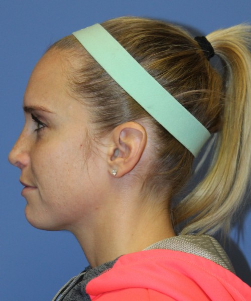 Revision Rhinoplasty 4285 – Click HERE for more views after photo. Individual results may vary.