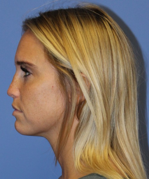 Revision Rhinoplasty 4285 – Click HERE for more views before photo. Individual results may vary.
