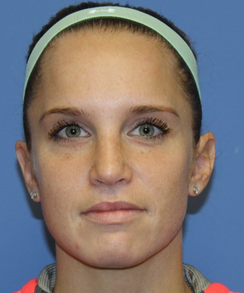 Revision Rhinoplasty 4285 – Click HERE for more views after photo. Individual results may vary.