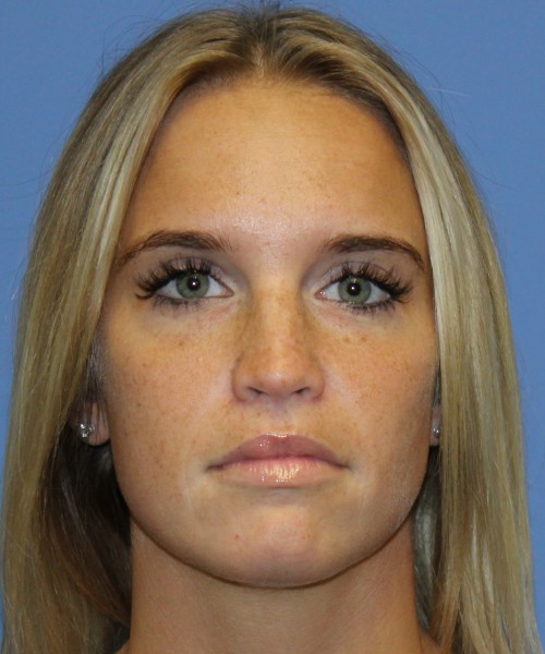 Revision Rhinoplasty 4285 – Click HERE for more views before photo. Individual results may vary.