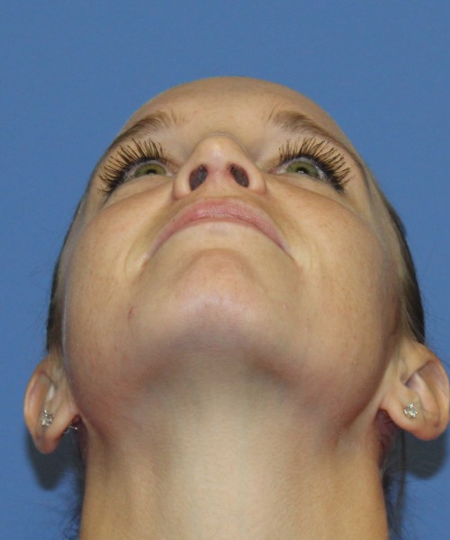 Revision Rhinoplasty 4285 – Click HERE for more views after photo. Individual results may vary.