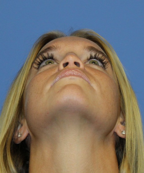 Revision Rhinoplasty 4285 – Click HERE for more views before photo. Individual results may vary.