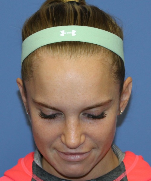 Revision Rhinoplasty 4285 – Click HERE for more views after photo. Individual results may vary.