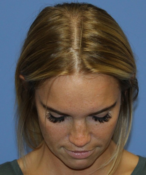Revision Rhinoplasty 4285 – Click HERE for more views before photo. Individual results may vary.