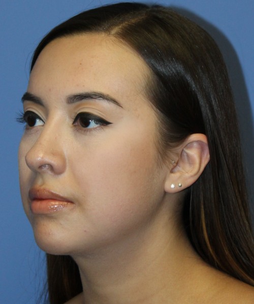 Dorsal Rhinoplasty 4317 – Click HERE for more views after photo. Individual results may vary.