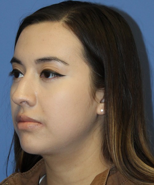 Dorsal Rhinoplasty 4317 – Click HERE for more views before photo. Individual results may vary.