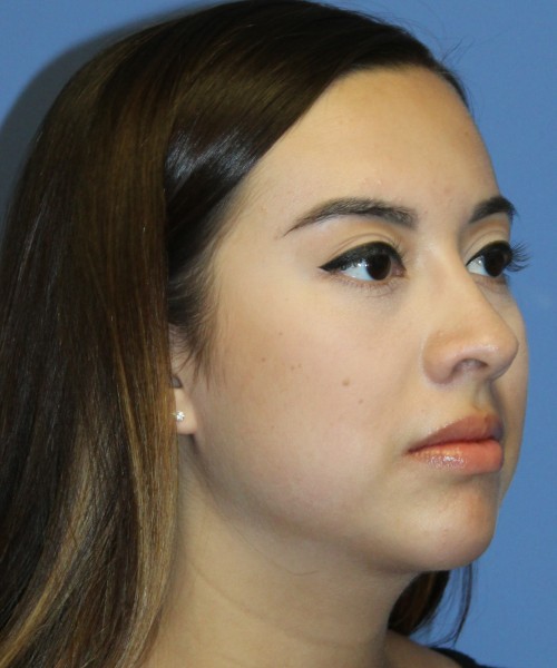 Dorsal Rhinoplasty 4317 – Click HERE for more views after photo. Individual results may vary.