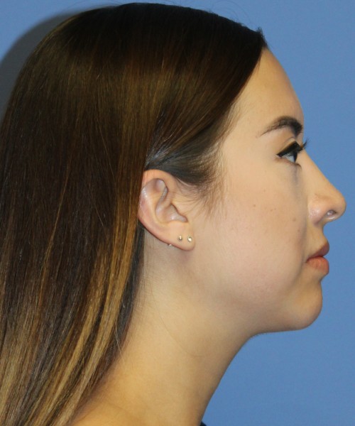 Dorsal Rhinoplasty 4317 – Click HERE for more views after photo. Individual results may vary.