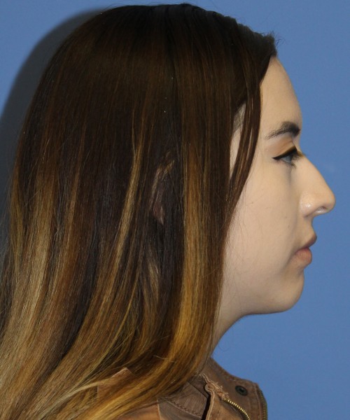 Dorsal Rhinoplasty 4317 – Click HERE for more views before photo. Individual results may vary.