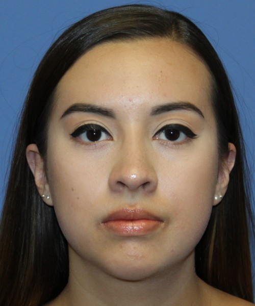 Dorsal Rhinoplasty 4317 – Click HERE for more views after photo. Individual results may vary.