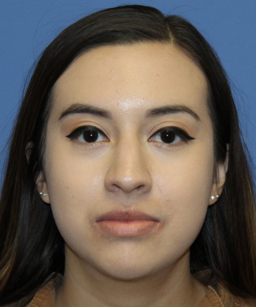 Dorsal Rhinoplasty 4317 – Click HERE for more views before photo. Individual results may vary.