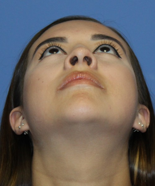 Dorsal Rhinoplasty 4317 – Click HERE for more views after photo. Individual results may vary.