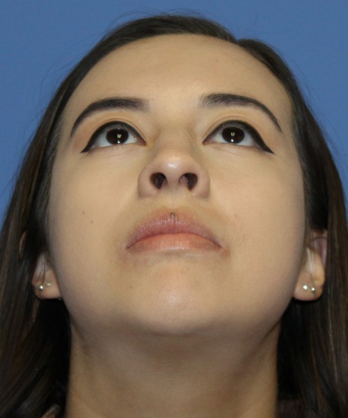Dorsal Rhinoplasty 4317 – Click HERE for more views before photo. Individual results may vary.