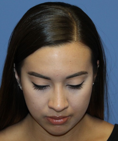 Dorsal Rhinoplasty 4317 – Click HERE for more views after photo. Individual results may vary.