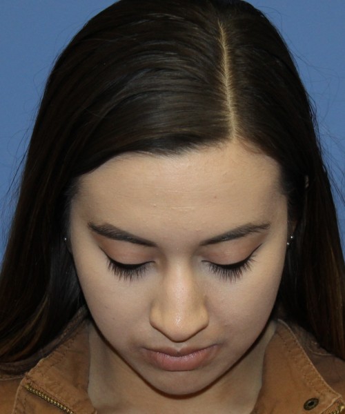 Dorsal Rhinoplasty 4317 – Click HERE for more views before photo. Individual results may vary.
