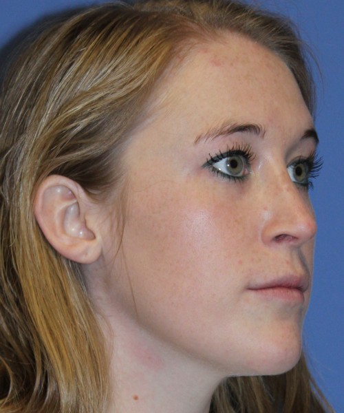 Rhinoplasty 4333 – Click HERE for more views after photo. Individual results may vary.