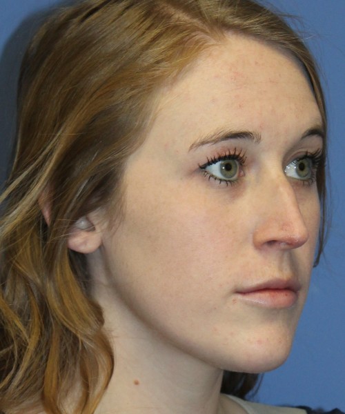 Rhinoplasty 4333 – Click HERE for more views before photo. Individual results may vary.
