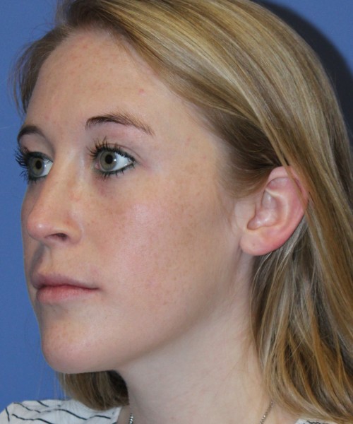 Rhinoplasty 4333 – Click HERE for more views after photo. Individual results may vary.