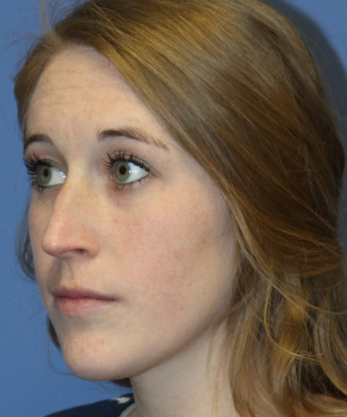 Rhinoplasty 4333 – Click HERE for more views before photo. Individual results may vary.