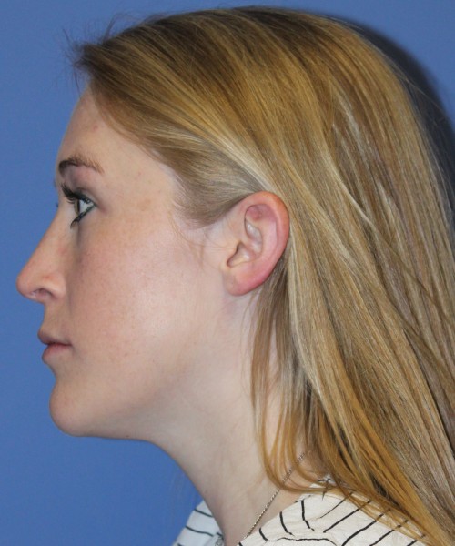 Rhinoplasty 4333 – Click HERE for more views after photo. Individual results may vary.