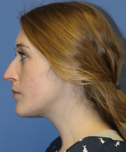 Rhinoplasty 4333 – Click HERE for more views before photo. Individual results may vary.