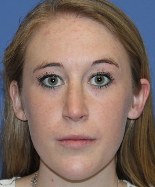 Rhinoplasty 4333 – Click HERE for more views after photo. Individual results may vary.