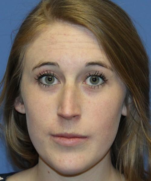 Rhinoplasty 4333 – Click HERE for more views before photo. Individual results may vary.