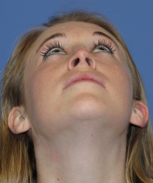 Rhinoplasty 4333 – Click HERE for more views after photo. Individual results may vary.