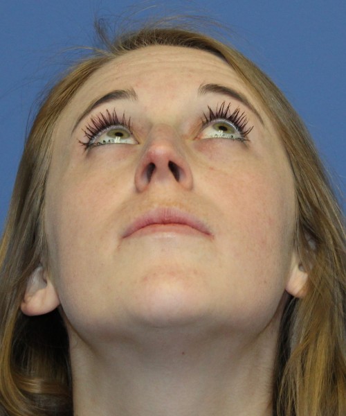 Rhinoplasty 4333 – Click HERE for more views before photo. Individual results may vary.