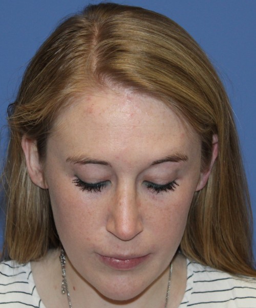 Rhinoplasty 4333 – Click HERE for more views after photo. Individual results may vary.