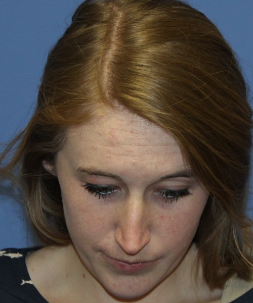 Rhinoplasty 4333 – Click HERE for more views before photo. Individual results may vary.
