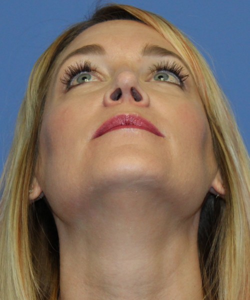 Rhinoplasty 4348 – Click HERE for more views after photo. Individual results may vary.