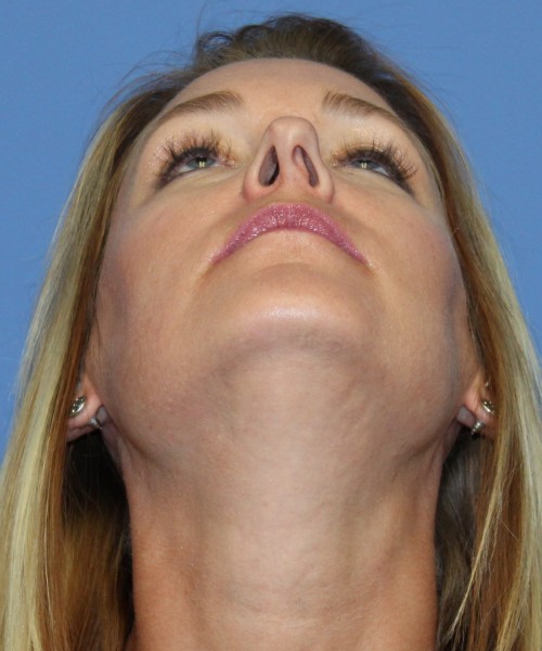 Rhinoplasty 4348 – Click HERE for more views before photo. Individual results may vary.
