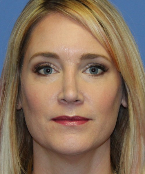 Rhinoplasty 4348 – Click HERE for more views after photo. Individual results may vary.