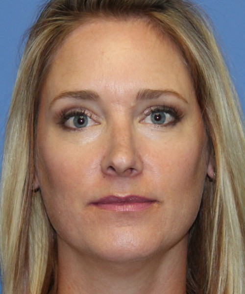 Rhinoplasty 4348 – Click HERE for more views before photo. Individual results may vary.