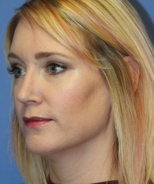 Rhinoplasty 4348 – Click HERE for more views after photo. Individual results may vary.
